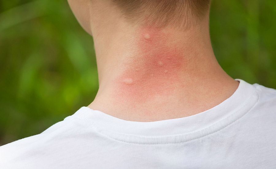 picaduras de mosquito